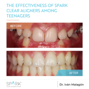 Before and After of Spark Clear Aligners